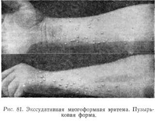 ERYTHEMA EXSUDATIVUM
MULTIFORME