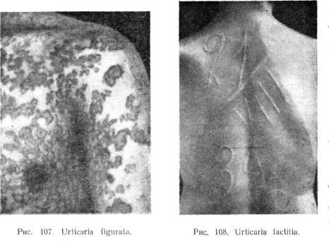 ����������, urticaria