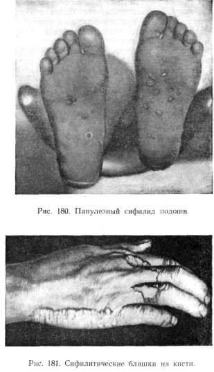 ���������� ������� (syphilis papulosa)