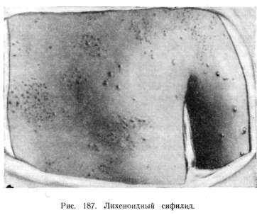 ���������� ������� (syphilis papulosa)