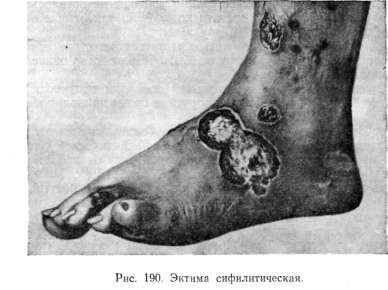 ����������� ������� (syphilis pustulosa, pustulae syphiliticae)