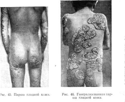 �����. 
����� ������� ���� (favus cutis glabrae)