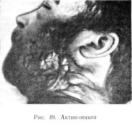 
����������� (ACTINOMYCOSIS) 