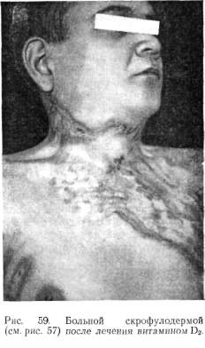 SCROPHULODERMA, TUBERCULOSIS COLLIQUATIVA.