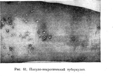 ������-������������� ���������� (TUBERCULOSIS CUTIS PAPULONECROTICA, ACNITIS, FOLLICLIS)